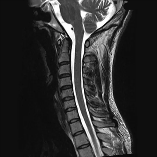 МРТ шейного отдела позвоночника. 0 степень - Физиологическое положение позвоночника и спинного мозга.